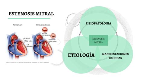 Estenosis mitral by Altamirano García Lizbeth on Prezi