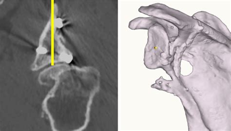 Ream And Run Shoulder Replacement Surgery Portsmouth Nh