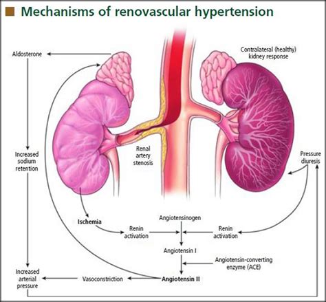 Renal Artery Stenosis