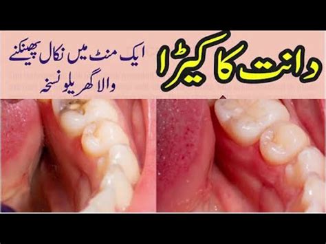 Dant Ka Keera Ka Ilaj Tooth Cavity Treatment In Urdu Hindi YouTube