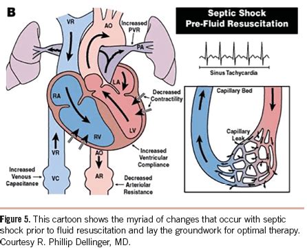 Septic Shock Fluid Resuscitation Epomedicine