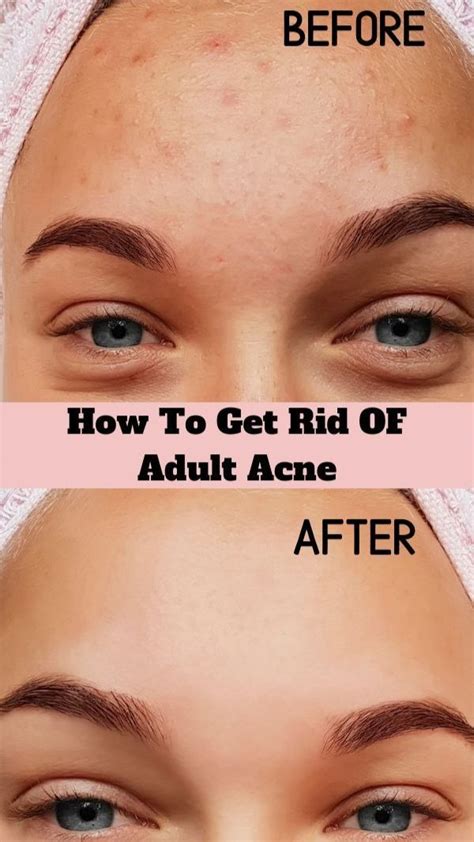 Getting Rid Of Adult Acne A Beginners Guide Opens A New Tab Best Acne Spot Treatment Acne