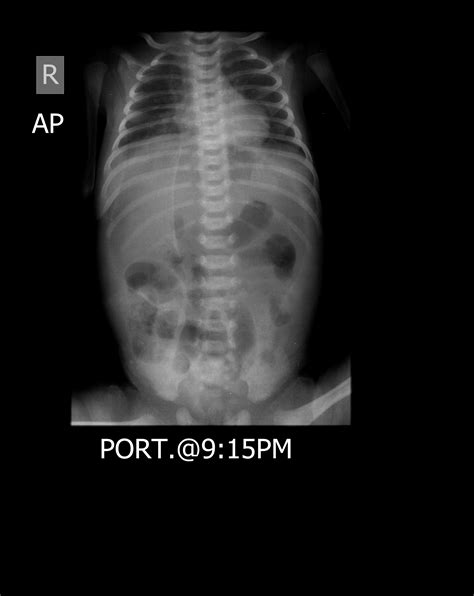 Pneumoperitoneum Related To Intestinal Perforation Image