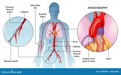 Angiography Operation Illustration Stock Vector Illustration Of