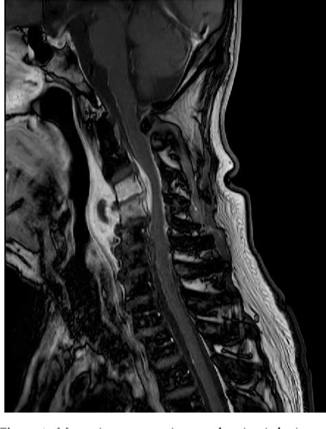 PDF The First Case Of Infectious Spondylitis Caused By Gemella