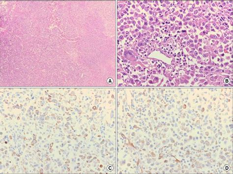 Histopathologic Findings Shows Round Tumor Cells Infiltrating