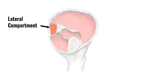 Lateral Compartment Syndrome Causes Symptoms Treatment