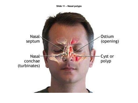 Nasal Polyps Anatomy