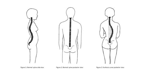 Scoliosis 101 What You Need To Know