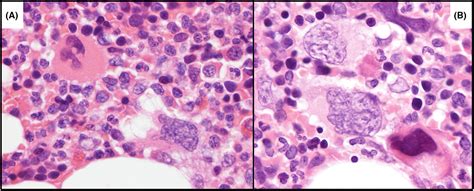 Myelofibrosis Teardrop Cells