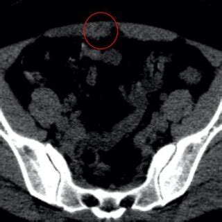 Abdominal Ultrasonography Image Of The X Mm Heterogeneous