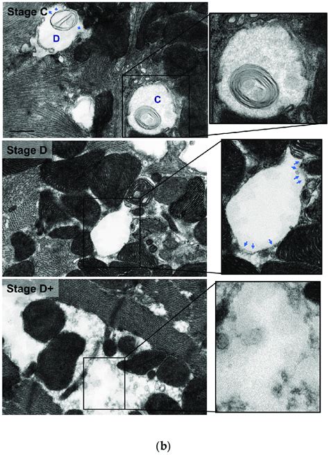 Morphological Stages Of Mitochondrial Vacuolar Degeneration In