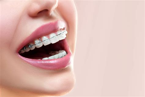 Clarity Ceramic Braces Vs Invisalign Andros Orthodontics Tri Cities