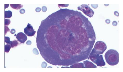 Ascitic Fluid Cytology Showing Large Immature Cells Some Of Which Are Download Scientific