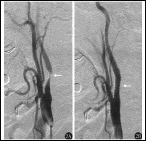 Observation Group A Severe Stenosis Of Right Internal Carotid Artery Download Scientific