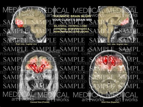 Traumatic brain injury - MRI colorization — Medical Art Works