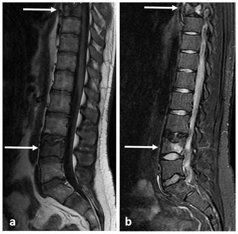 Diagnostics Free Full Text Primary Benign Neoplasms Of The Spine