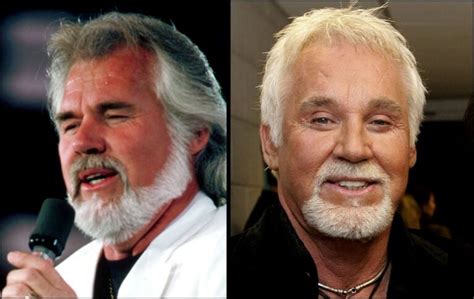 Kenny Rogers Botox And Nose Job - Before And After Surgery