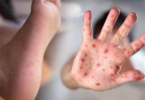 Hand Foot And Mouth Disease HFMD Health Insure Savvy