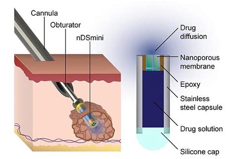 Implantable Drug Delivery Device Can Target Tumors