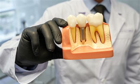 The Life Changing Benefits Of Dental Implants