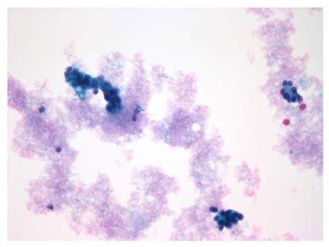 Thyroid Follicular Cells In A Microfollicular Pattern Thy 3 Download Scientific Diagram