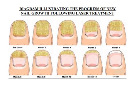 Laser Nail Therapy in Marlborough, CT | Dr. Stuart Jablon | Podiatrist