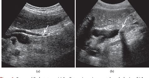 Common Bile Duct Stone Ultrasound