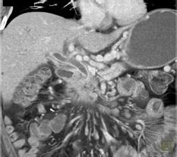 Pancreatic Cancer Occludes Portal Vein And Infiltrates Mesentery