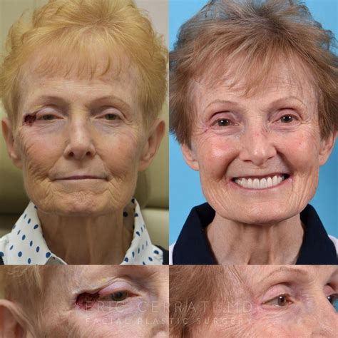 Salt Lake City Ut Facial Reconstructive Surgery Before And After Pictures