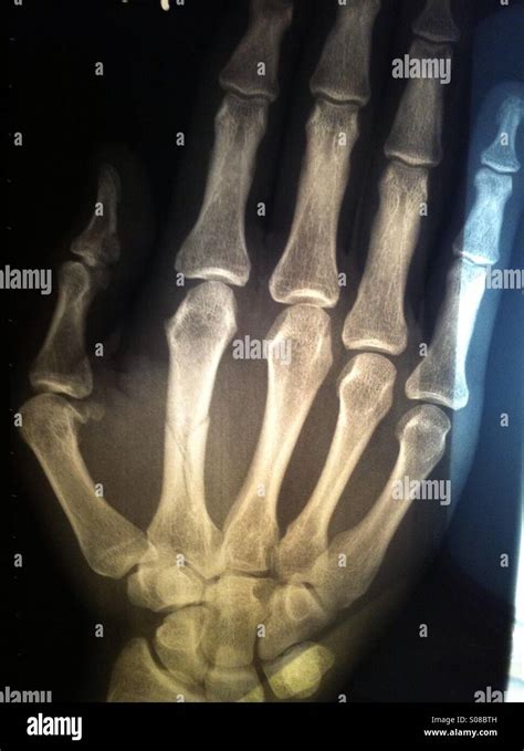 Broken Hand X Ray High Resolution Stock Photography And Images Alamy