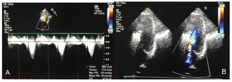 Hypertrophic Obstructive Cardiomyopathy With Sam Phenomenon A Case