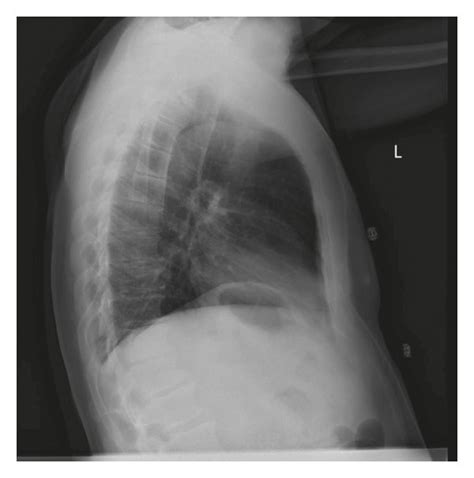 Frontal A And Lateral B Chest X Ray Images Demonstrating No