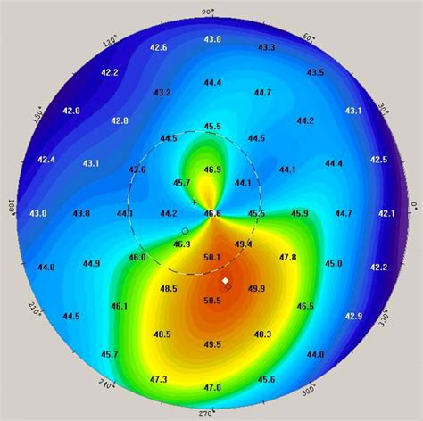 público Cuarto Congelar topografía corneal anormal tortura orquesta