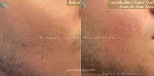 Laser Skin Resurfacing Before And After Photo Gallery New York City