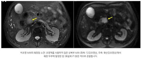 Mri 췌장암 조기진단 어떤 검사가 좋을까요 네이버 블로그