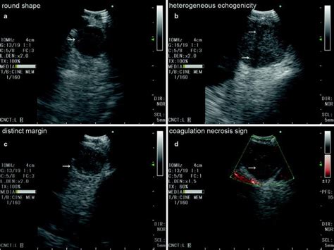 Linear Endobronchial Ultrasound Springerlink