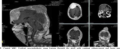 Figure From Multiple Myeloma And Paget Disease With Abnormal Skull