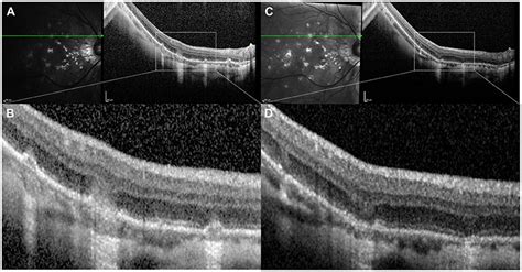 Frontiers Key Multimodal Fundus Imaging Findings To Recognize