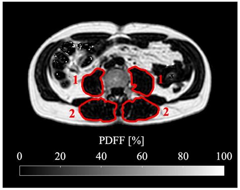 Psoas Muscle Mri