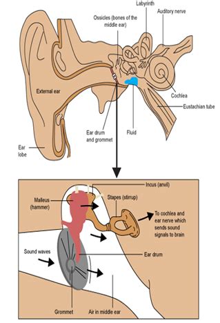 Grommet Insertion Surgery India,Cost Grommet Insertion Surgery Abroad