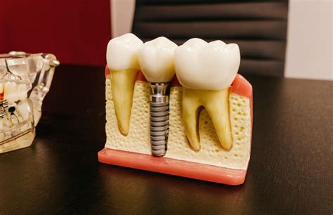 Implantes dentales complicaciones a largo plazo Clínica Nelken