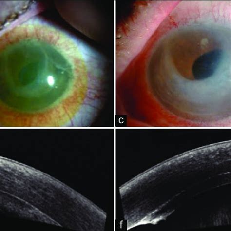 Slit Lamp Photographs And Anterior Segment Optical Coherence Tomography