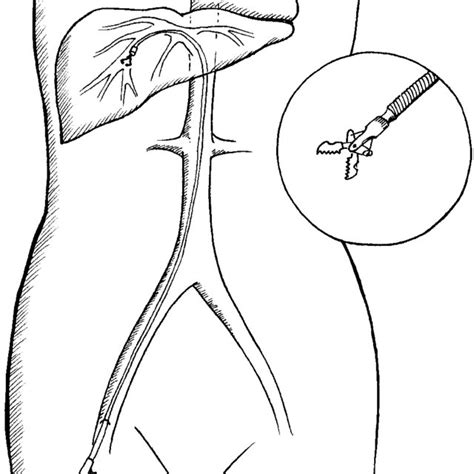 diagrammatic representation showing placement   curved sheath