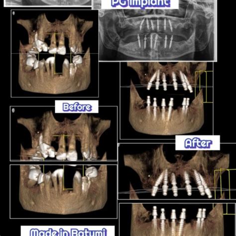 Immediate Implantation SGS Dental Implants System SGS Dental Dental