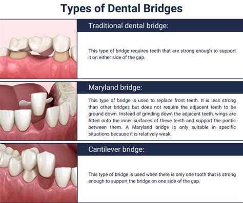 Dental Implants Vs Bridges Finding Whats Best For You