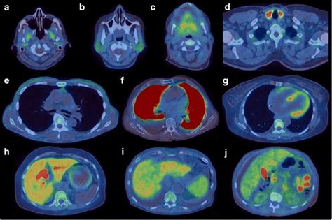 Transaxial ¹⁸F florbetapir fused PET CT images showing representative