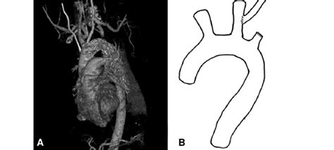 Tevar With Subclavian Carotid Bypass For A Patient With Traumatic Download Scientific Diagram