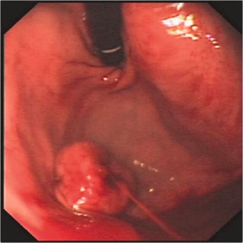 Upper Gi Endoscopy Revealed A Bleeding Submucosal Tumor In The Stomach