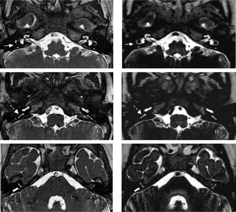 Axial 3d Bffe A C E And 3d Drive B D F At Level Of The Lateral Download Scientific Diagram